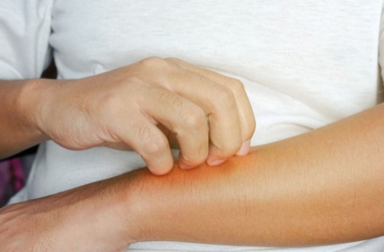 Kenali 5 Penyakit Gatal Di Kulit: Gejala, Penyebab, Cara Mengatasi